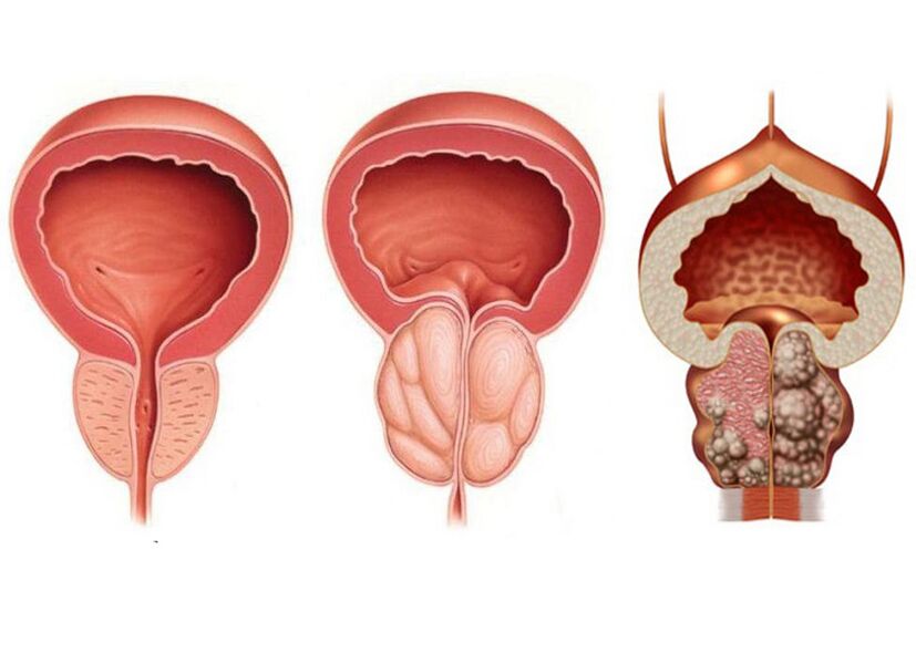 stopnje prostatitisa in potreba po celotni uporabi prostavita