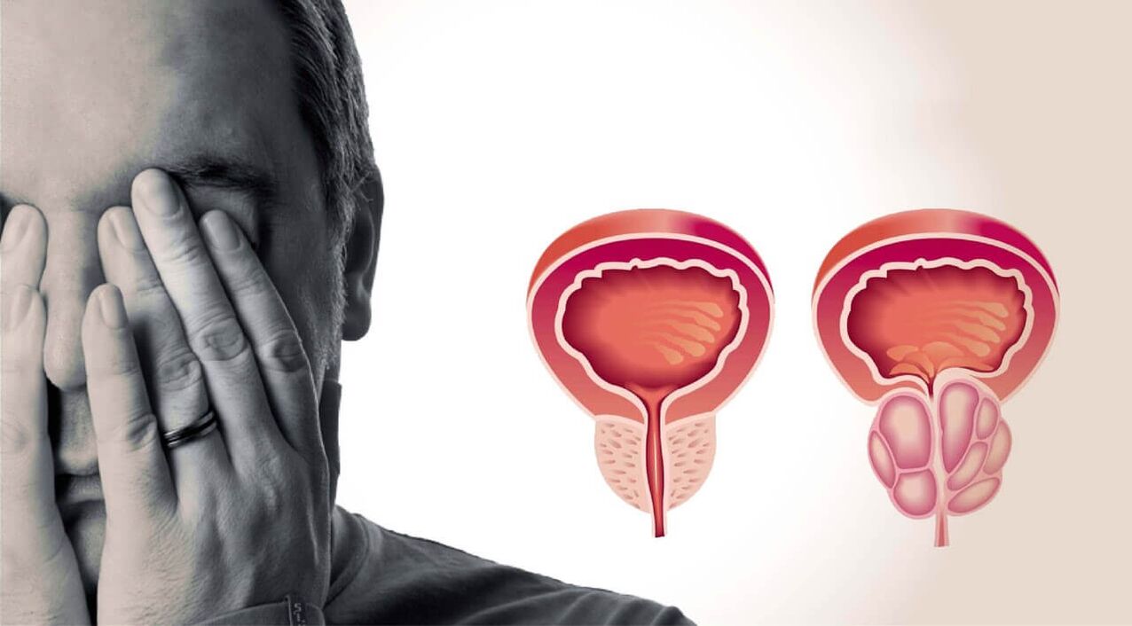 Zdrava in boleča prostata pri moških